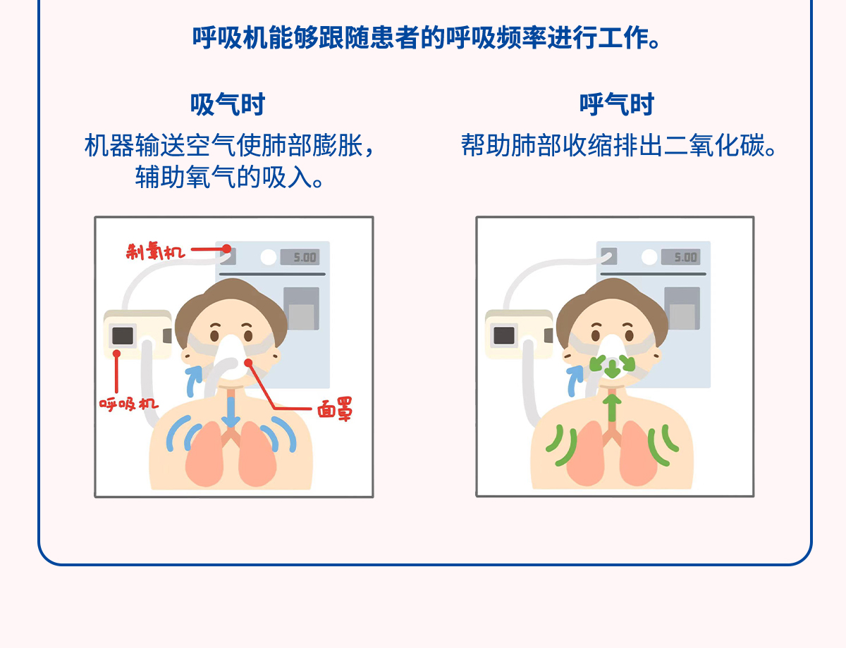 家庭无创通气